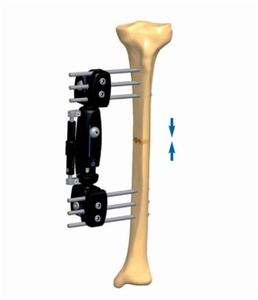 TIBIA 3.1