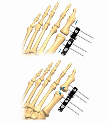 FOOT 5.1