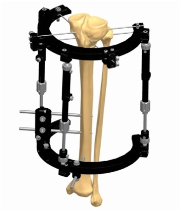 KNEE 1.2