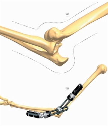 Elbow 1.1