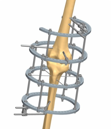 KNEE 2.1