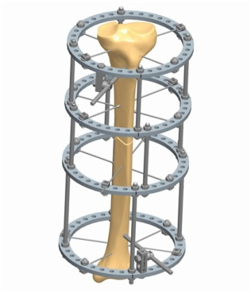 TIBIA 1.4
