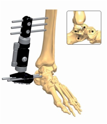 ANKLE 2.1