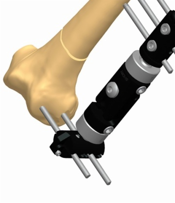 FEMUR 1.7