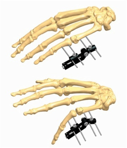 Hand 1.5