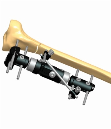 TIBIA 1.8