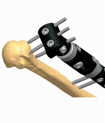 HUMERUS 1.4