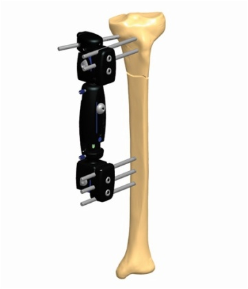 TIBIA 1.2
