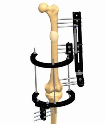 KNEE 3.1