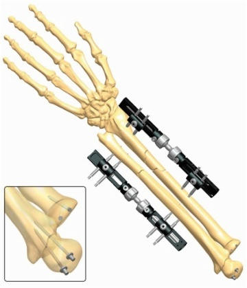 FOREARM 1.3