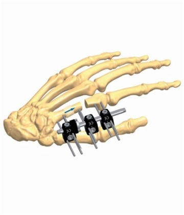 Hand 6.1