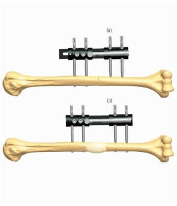 HUMERUS 4.1