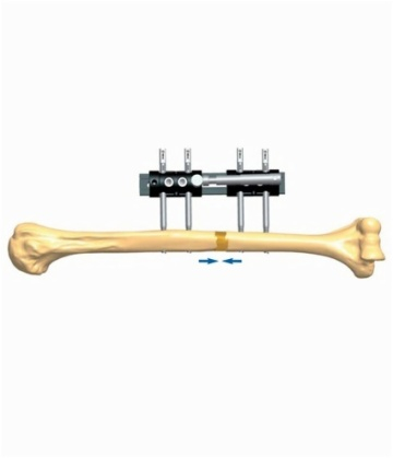 HUMERUS 3.3