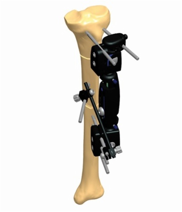 TIBIA 1.7
