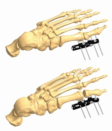 FOOT 1.4