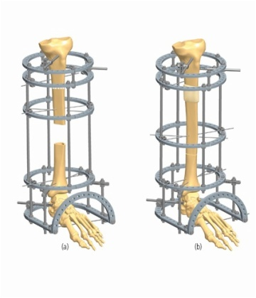 TIBIA 6.5